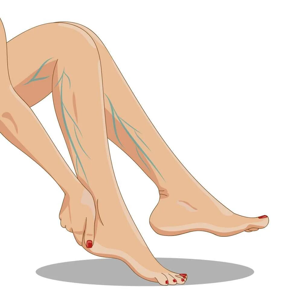 Руки и ноги коликами. Мультяшные ноги. Женские варикозные ноги. Нога мультяшная. Варикозные ноги мультяшно.