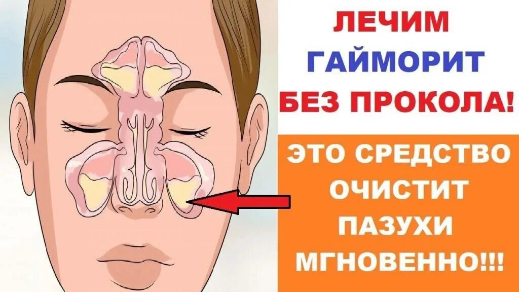 Насморк при гайморите у взрослых. При гайморите взрослым. синусит и гайморит лекарство.