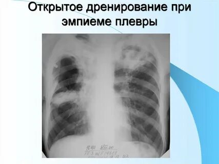 Пиоторакс с фистулой