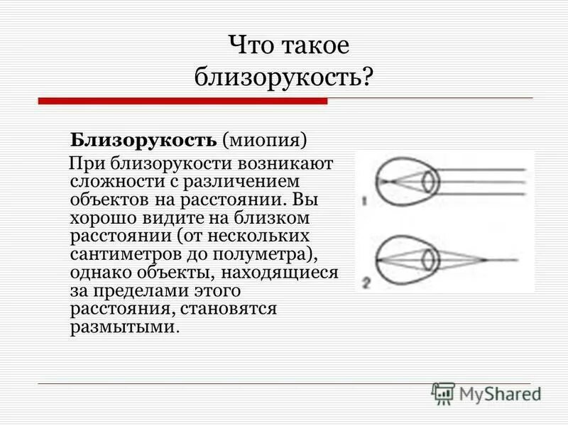 Близорукость. Прогрессирующая близорукость. Зрение при близорукости. Почему развивается близорукость.