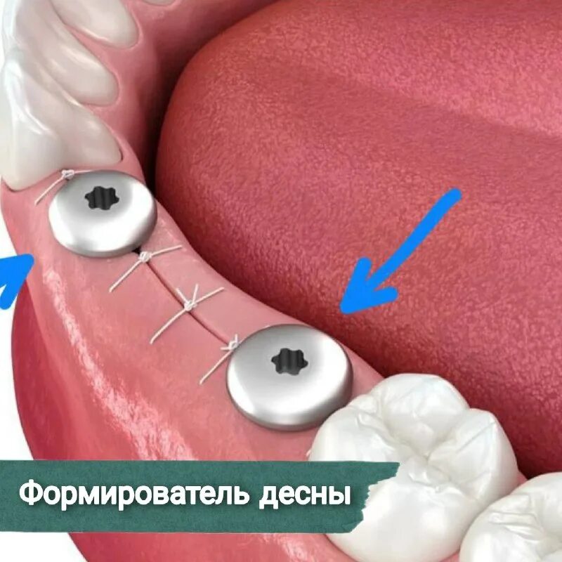 80мм h3мм a-tmgr-380-3. Что такое формирователь десны. Формирователь десны astra. Этапы имплантации зубов. Формирователь на имплант.