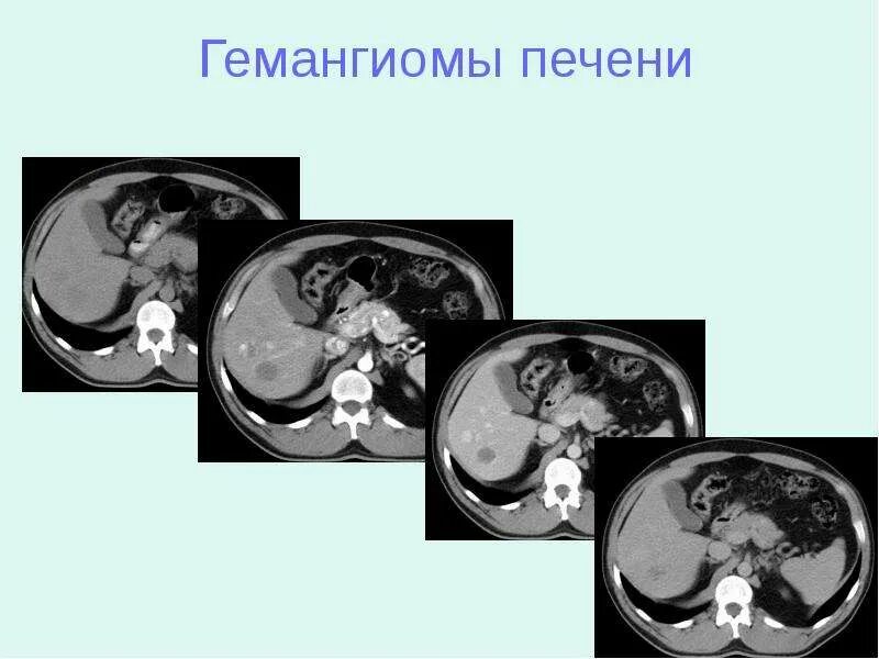 Гиподенсивное образование в печени. Гиподенсный очаг печени кт. Нодулярная гиперплазия печени на кт. Фокальная нодулярная гиперплазия печени на кт. Фибронодулярная гиперплазия печени.