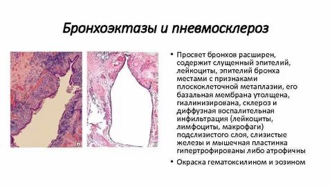Расширение просвета