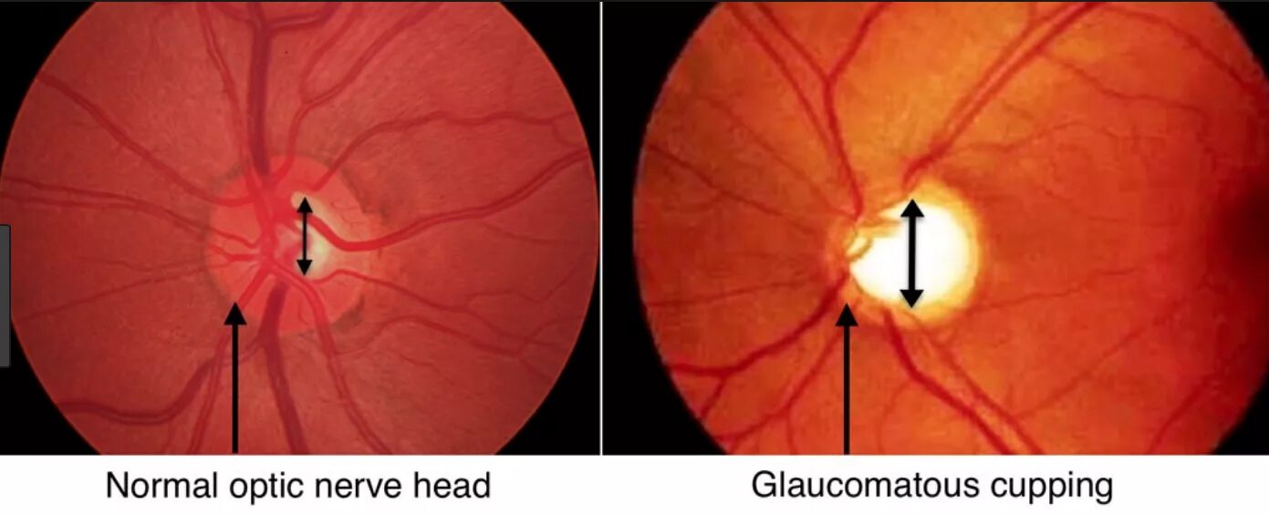 Зрительный нерв при глаукоме. Офтальмоскопия глазного дна. Зрительный нерв глаукома. Глаукома диск зрительного нерва. Открытоугольная глаукома на офтальмоскопии.
