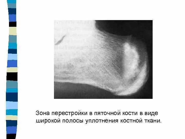 Зона перестройки. Уплотнение костной структуры рентген. Лоозеровские зоны перестройки большеберцовой кости. Лоозеровские зоны перестройки большеберцовой кости рентген. Уплотнение костной ткани на рентгене.