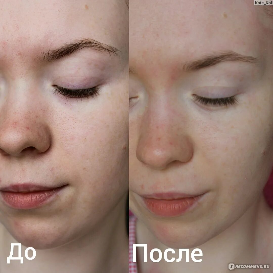 Альгинатная маска до и после. Альгинатные маски до после. Led маска до и после фото. Чистка лица и альгинатная маска до и после.