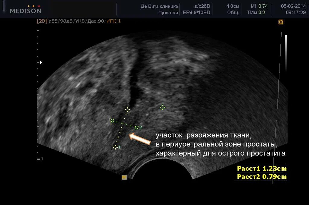 Хронический простатит предстательной железы. Опухоль предстательной железы УЗИ. Снимки УЗИ аденомы простаты. Измерение предстательной железы при трузи. Гиперплазия простаты трузи.