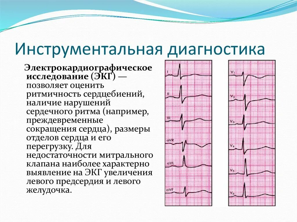 Показывает ли экг сердечную недостаточность. Изменения экг при митральной недостаточности. экг при митральной недостаточности. экг признаки митральной недостаточности. экг при недостаточности митрального клапана.