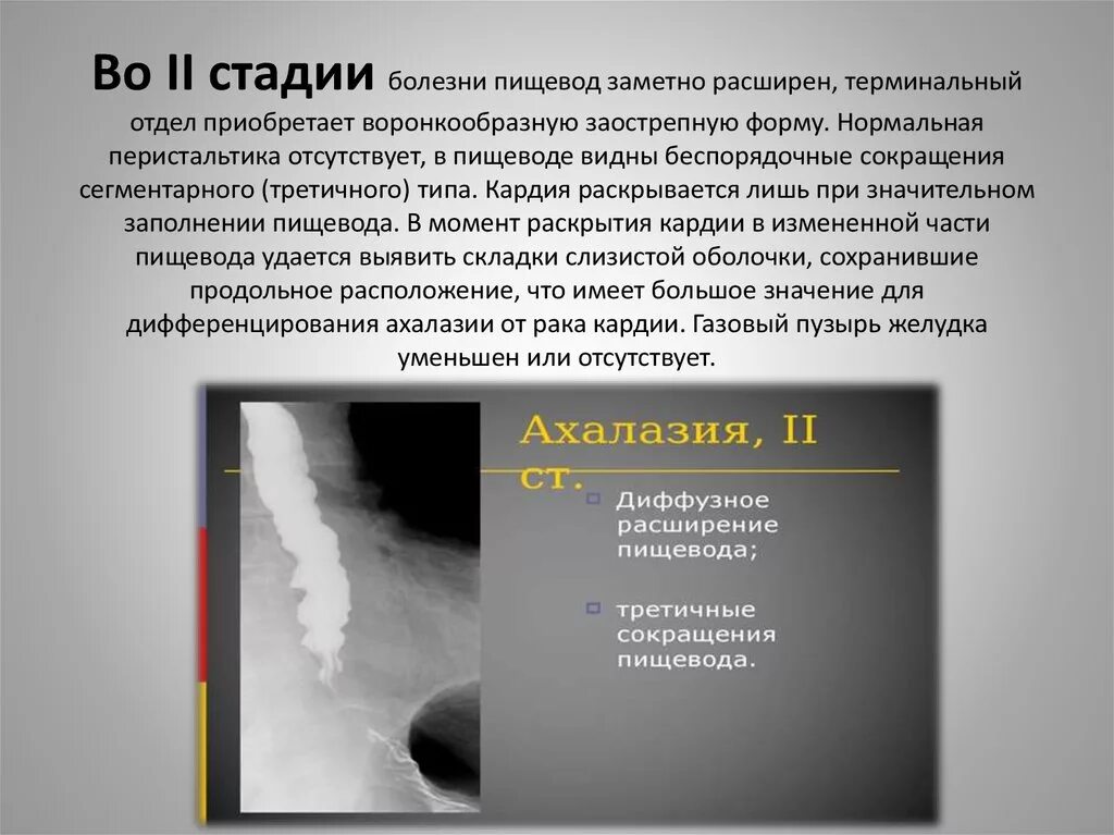 Степени расширения пищевода. Ахалазия рентген стадии. Ахалазия пищевода рентген степени. Ахалазия пищевода 3 степени рентген. Ахалазия пищевода рентген описание протокола.