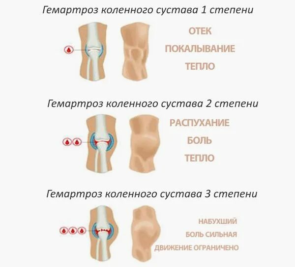 Через 1 стадии. Гемартроз коленного сустава при травме. Гемартроз коленного сустава 1 стадии. Гемартроз коленного сустава при гемофилии.