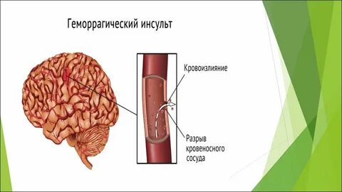 Терапевтическое окно ишемического инсульта