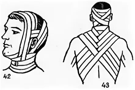 Повязки на шею десмургия. Перевязка шеи бинтом. Восьмиобразная повязка на затылок и шею. Крестообразная повязка на затылок алгоритм. Повязки на голову шею