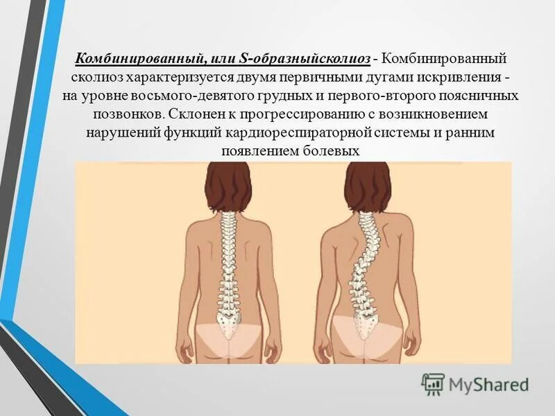 Массаж при s образном сколиозе. Комбинированный сколиоз. сколиоз характеризуется. комбинированный сколиоз 1-2 степени. дуга искривления при сколиозе.