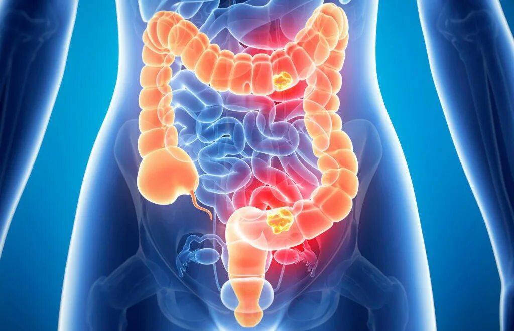 Запор микрофлора кишечника. Микробиота кишечника. Кишечник бактерии микробиом. Кишечная микробиота. Запор микрофлора кишечника.