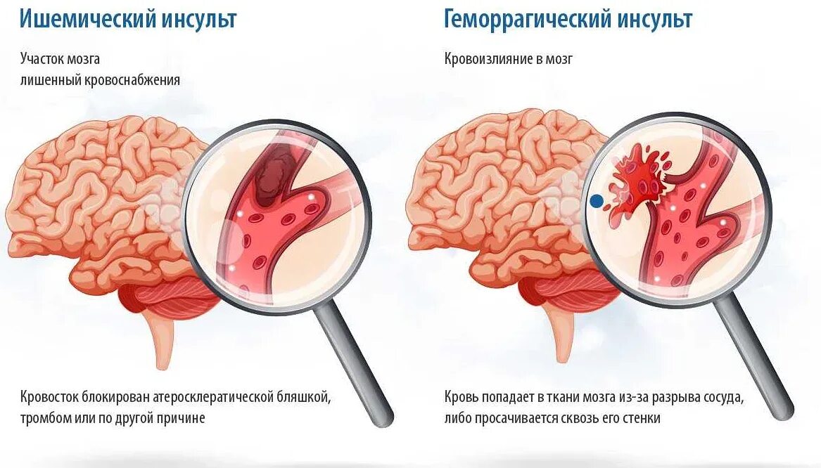 Ишемия головного мозга у пожилых людей