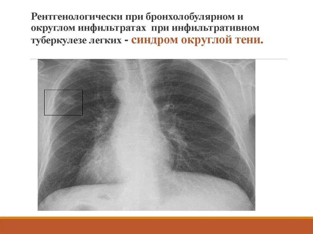 Округлый инфильтрат. Бронхолобулярный инфильтративный туберкулез рентген. Бронхолобулярный инфильтрат рентген. Инфильтративный туберкулез легких s1 s2. Инфильтрационный туберкулез рентген.