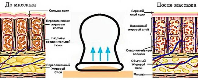 Действие банок. Воздействие вакуумного баночного массажа на кожу. Баночный массаж принцип действия. Вакуумный массаж схема. Вакуумный массаж принцип действия.