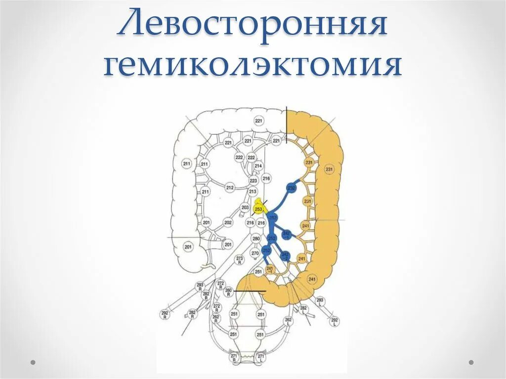 Операция левосторонняя гемиколэктомия. Операция левосторонняя гемиколэктомия. Операция левосторонняя гемиколэктомия. Правосторонняя гемиколэктомия схема операции. Левосторонняя гемиколэктомия.