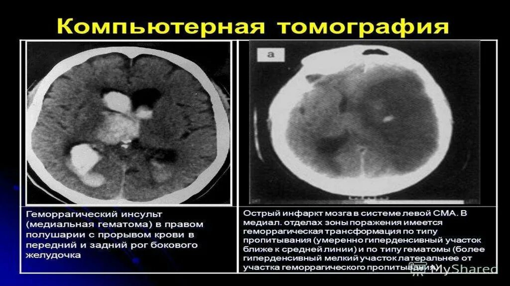 Геморрагическая трансформация ишемического инсульта кт. Кт головного мозга при геморрагическом инсульте. Геморрагический инсульт гематома. Геморрагический инсульт мозжечка на кт.