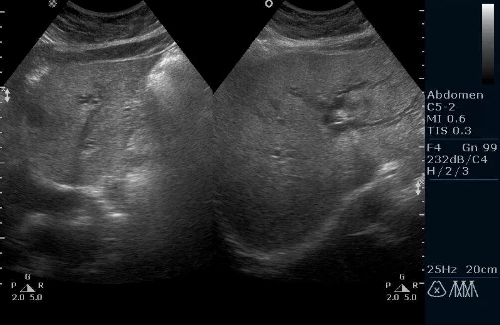 Как выглядят метастазы на узи. Трансабдоминальное узи желудка. Можно ли увидеть метастазы на узи. Объемные образования печени на узи. Эхограмма печени с метастазами.