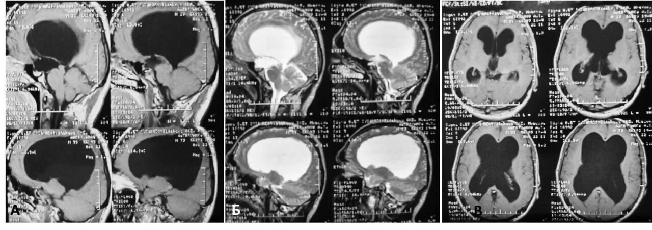 Диета при гидроцефалии мозга. Наружная заместительная гидроцефалия.