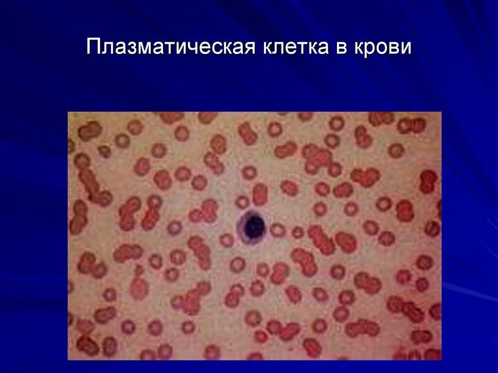 1 плазматическая клетка. Плазмоклеточный лейкоз. Плазматические клетки в крови клетка. Плазматические клетки под микроскопом. Плазматические клетки плазмоциты.
