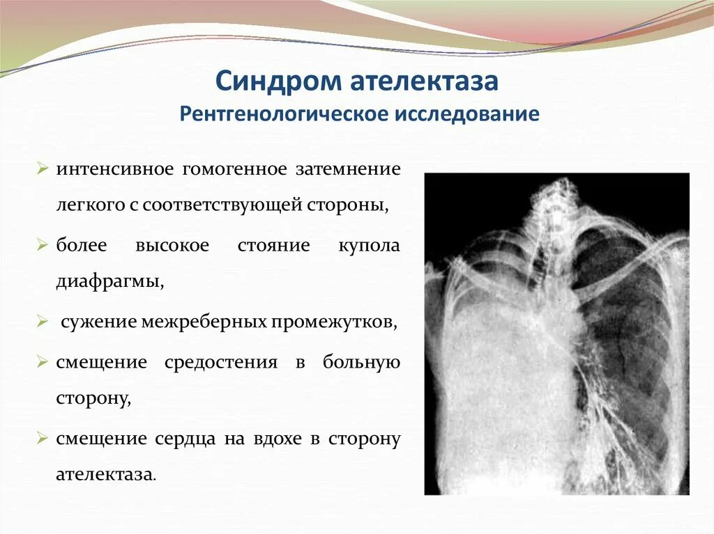 Обтурационный ателектаз легкого. Синдром ателектаза. Рентгенодиагностика ателектазов легких. Гомогенное затемнение легкого что это такое. Синдром ателектаза легких.