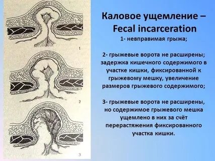 Грыжа ощущения