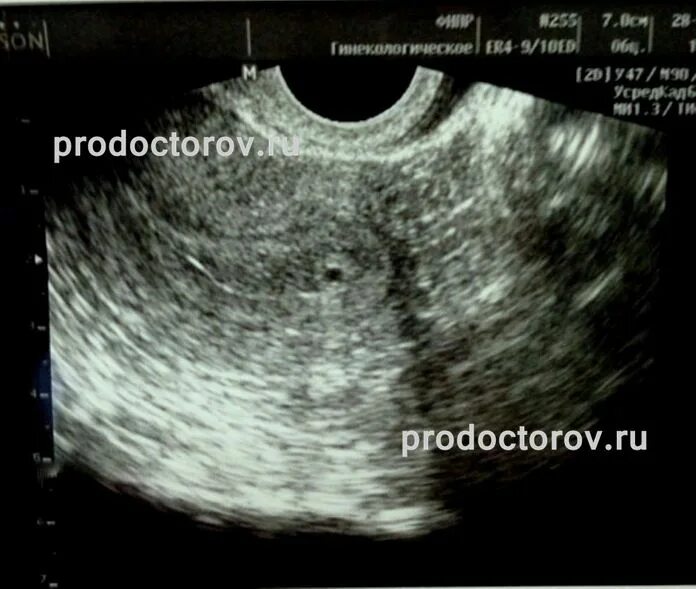 Узи 1 2 недели беременности