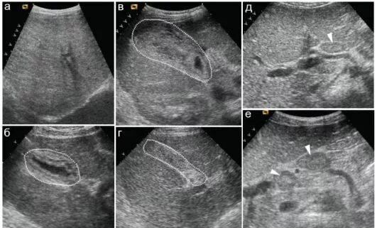 Гиперэхогенные включения в желчном пузыре. Гиперэхогенный желчный пузырь УЗИ. Аденомиоматоз желчного пузыря. Гепатоспленомегалия на УЗИ. Гипоплазия желчного пузыря на УЗИ.