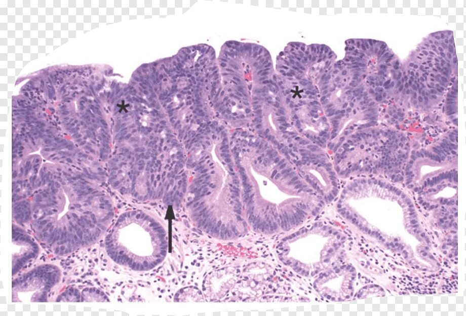 Пищевод Барретта метаплазия эпителия. Пищевод Барретта гистология. Пищевод Барретта аденокарцинома. Аденокарцинома Барретта гистология.