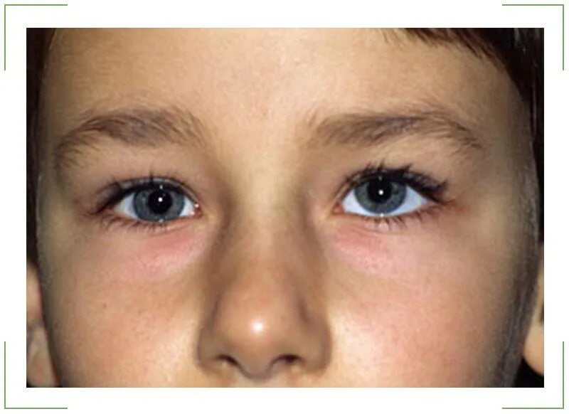 Паралитическое вертикальное косоглазие. Гетерофория глаза. Косоглазие у детей. Косит глаз причины