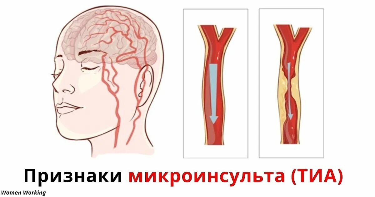 Признаки микроинсульта у женщины перенесенного. Симптоматика микроинсульта. Микроинсульт у женщин. Микроинсайт. Критерии микроинсульта.