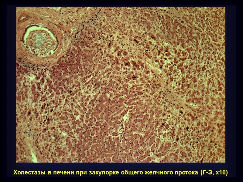 Желчные пигментации