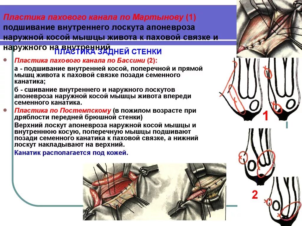 Способы пластики паховых грыж