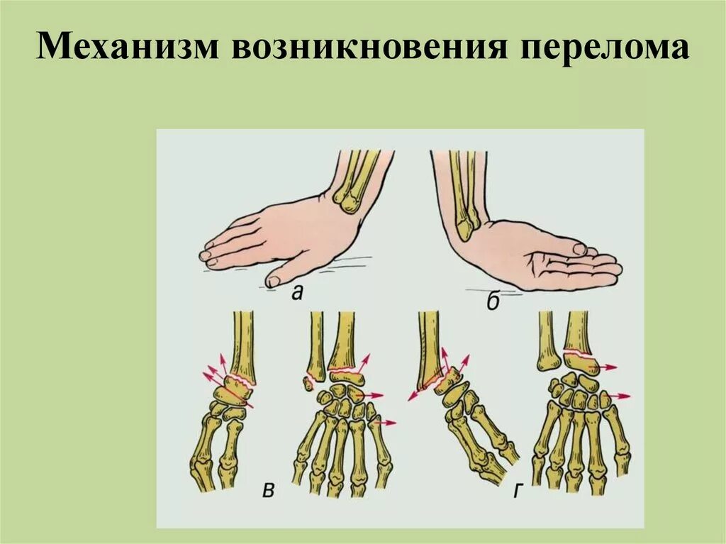 Бурсит запястного сустава. Воспаление суставной сумки лучезапястного сустава.