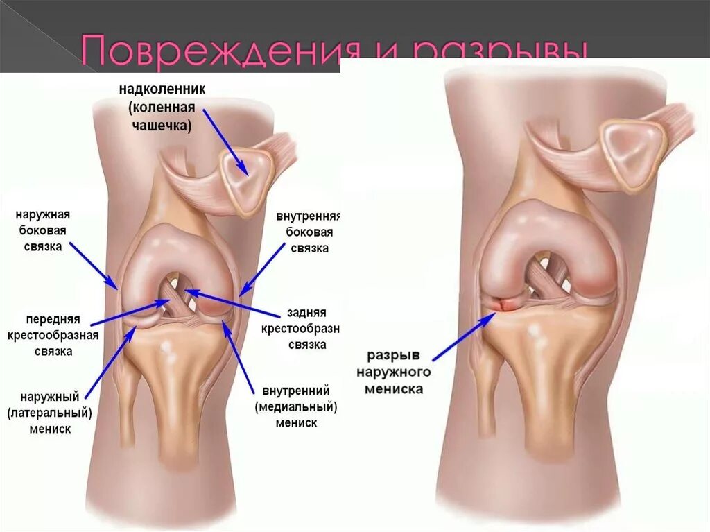 Болит ли мениск. Медиальный мениск коленного сустава. Растяжение медиального мениска. Менископатия медиального мениска. Сепарация латерального мениска.