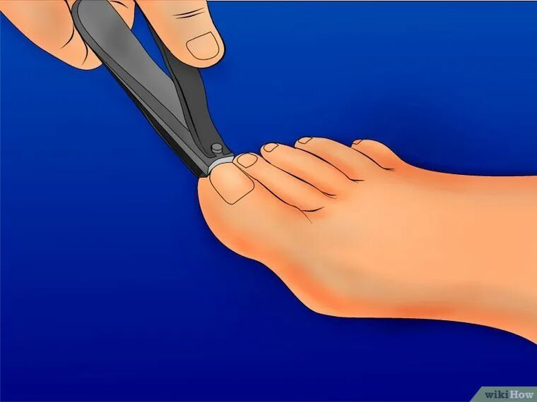Правильная стрижка ногтей на ногах. Неправильная стрижка ногтей. Срезание ногтей на ногах. Как подстригать ногти на большом пальце