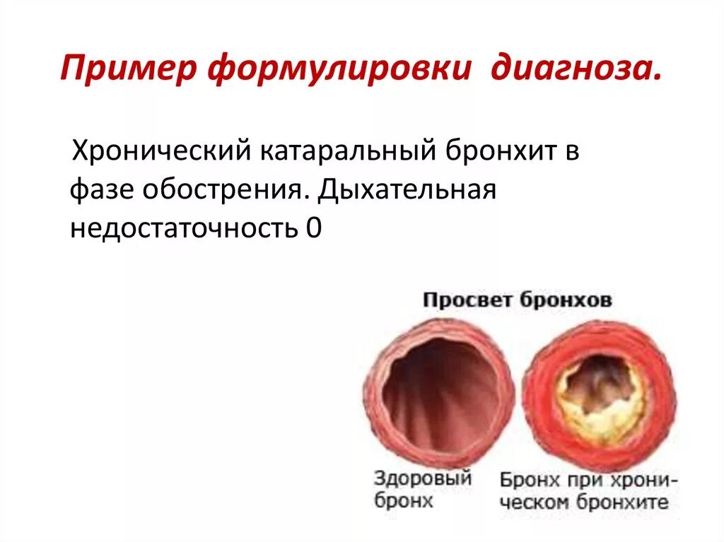 Бронхит россия. Диагноз острый обструктивный бронхит формулировка диагноза. Острый Гнойный бронхит формулировка диагноза. Хронический бронхит формулировка диагноза. Острый и хронический бронхит.