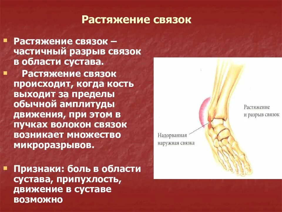 Что значит растяжение. Растяжение и разрыв связок. • растяжение, повреждение связок.