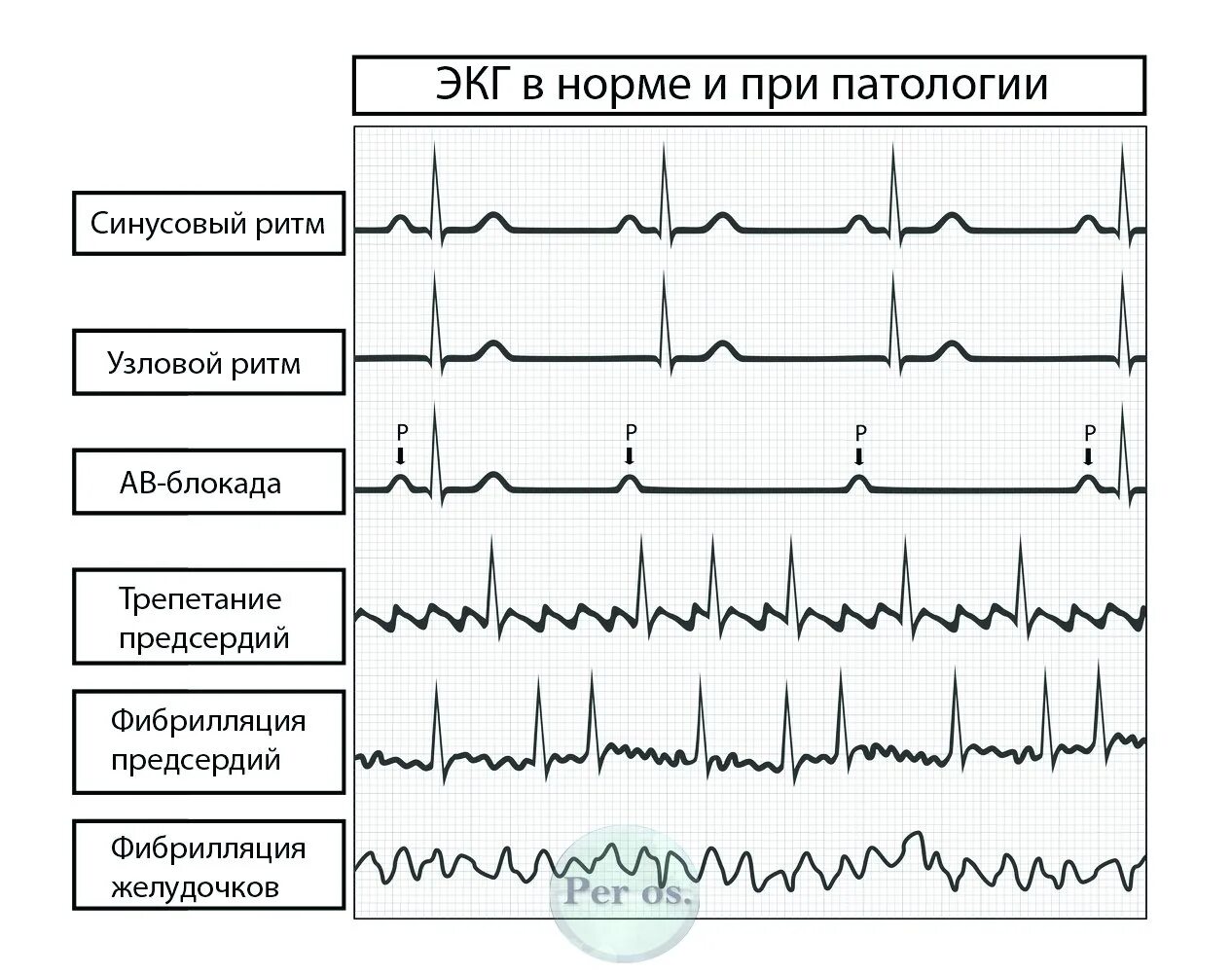 Кардиограмма сердца расшифровка норма и патология. ЭКГ сердца расшифровка патология. ЭКГ нормальные показатели и патология. ЭКГ норма расшифровка кардиограммы показатели. Тяжелое экг