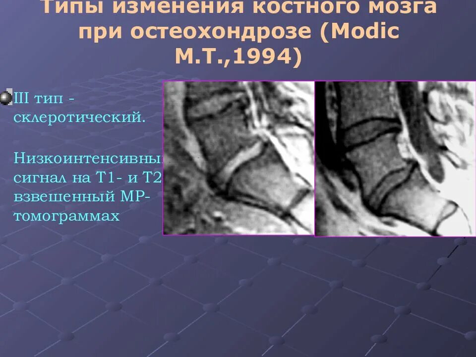 Лучевая диагностика костного мозга. Изменения костного мозга по Modic. Изменения костного мозга по типу модик. Жировая перестройка костного мозга мрт.