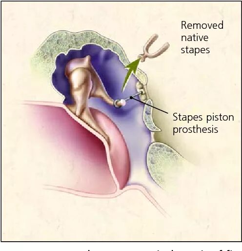 Отосклероз операция стапедопластика. Отосклероз уха операция