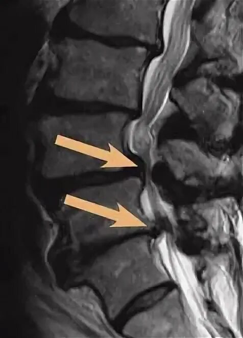 Поясничный абсолютный стеноз. Стеноз позвоночного канала мрт. Артрогенный стеноз позвоночного канала мрт. Абсолютный стеноз позвоночного канала мрт. Стеноз позвоночного канала поясничного отдела мрт.