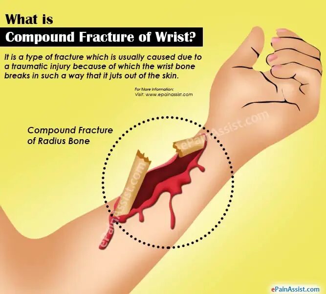Compound fracture. Compound fracture. Compound fracture. Порезал палец до кости. Compound fracture.