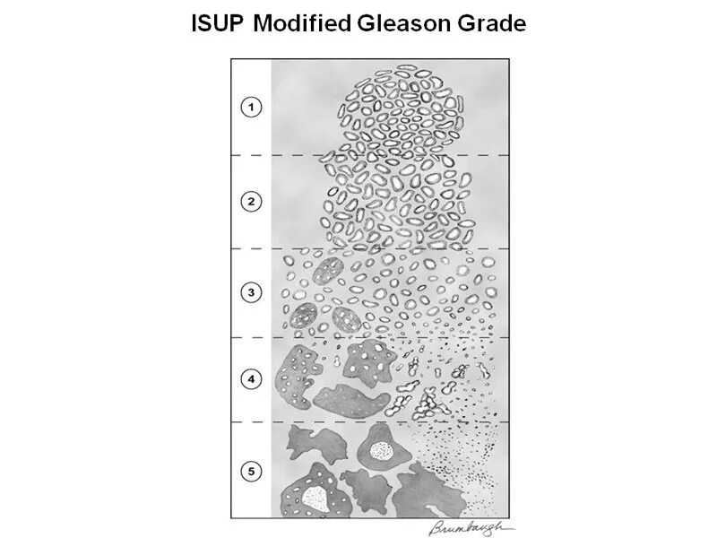 Глисон простата. Gleason классификация. Глисон градация. Глиссон шкала. Gleason score.