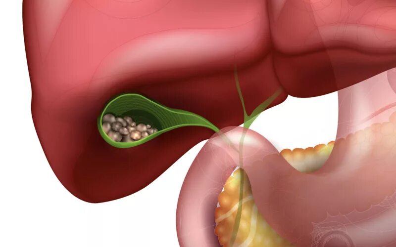 Жкб заболевания. Желчекаменная болезнь. Желчнокаменная болезнь (холелитиаз). ЖКБ камни желчного пузыря.