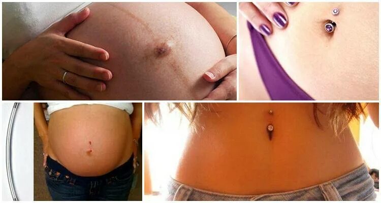 Почему во время пупок. Пирсинг выпуклого пупка. Пупочная грыжа у беременных. Почему во время пупок. Прокол пупка после родов.