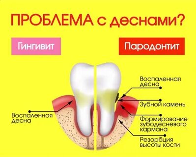 Пародонтит лечение лекарства
