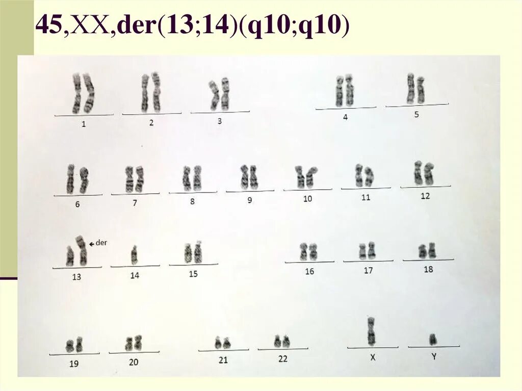 Кариотип 46 XY(11). 45 ХХ кариотип. Кариотип 46 ХХ. Кариотип 45 XX(+13/13)..